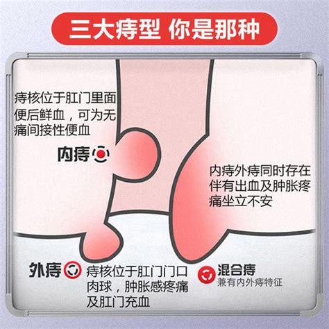 為什麼會長痔|痔瘡症狀有分1